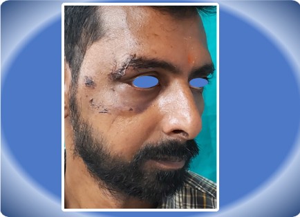 MAXILLOFACIAL INJURY